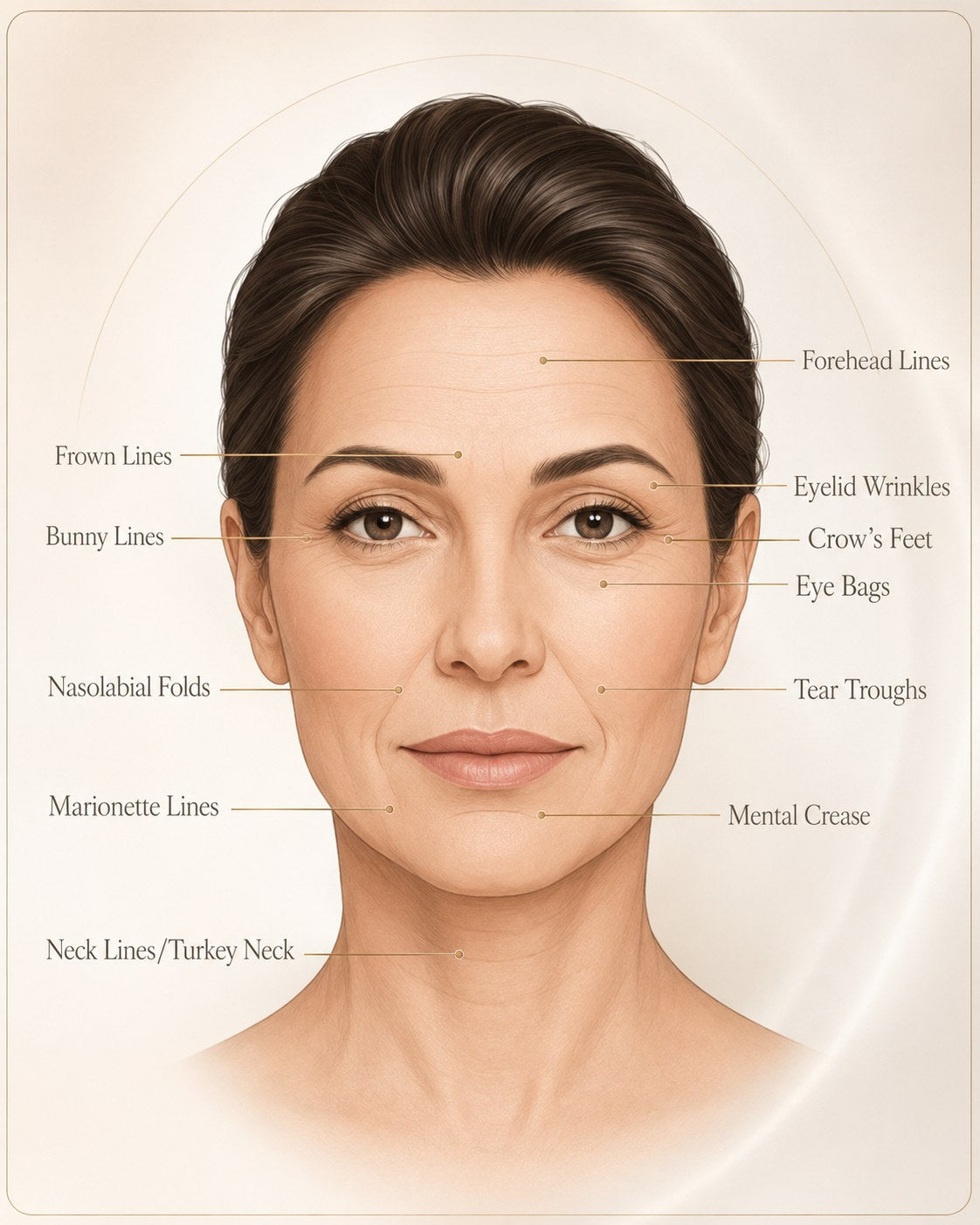 Illustrated face diagram labeling common line areas: forehead lines, frown lines, crow's feet, eye bags, nasolabial folds, marionette lines, and neck lines